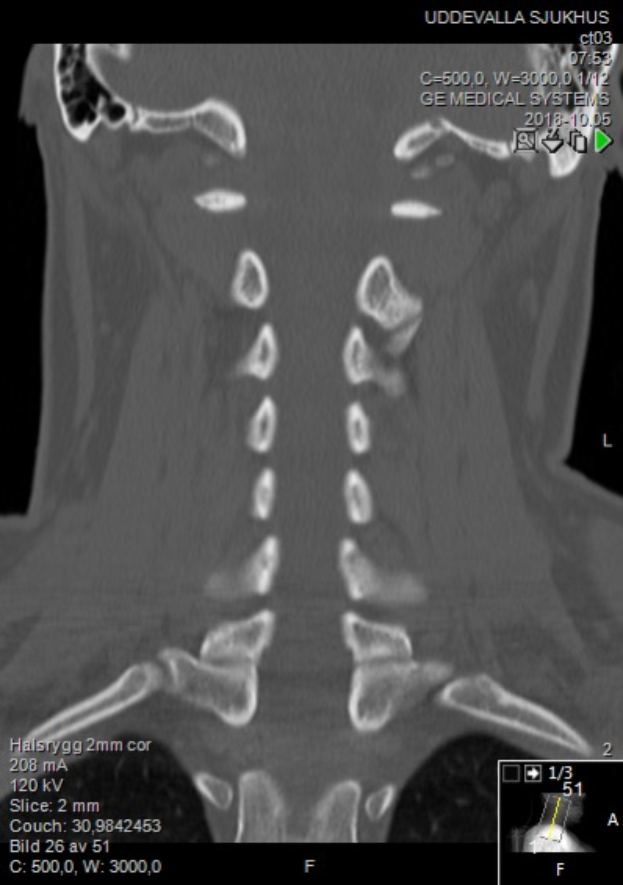Eine MRT-Aufnahme eines Mannes mit einem Halsbruch, auf einem Computerbildschirm angezeigt, zeigt Größe, Form und Lage des Bruchs.